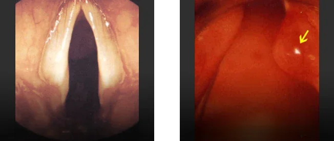 정상 성대와 성대 폴립의 후두 정밀내시경 소견 비교